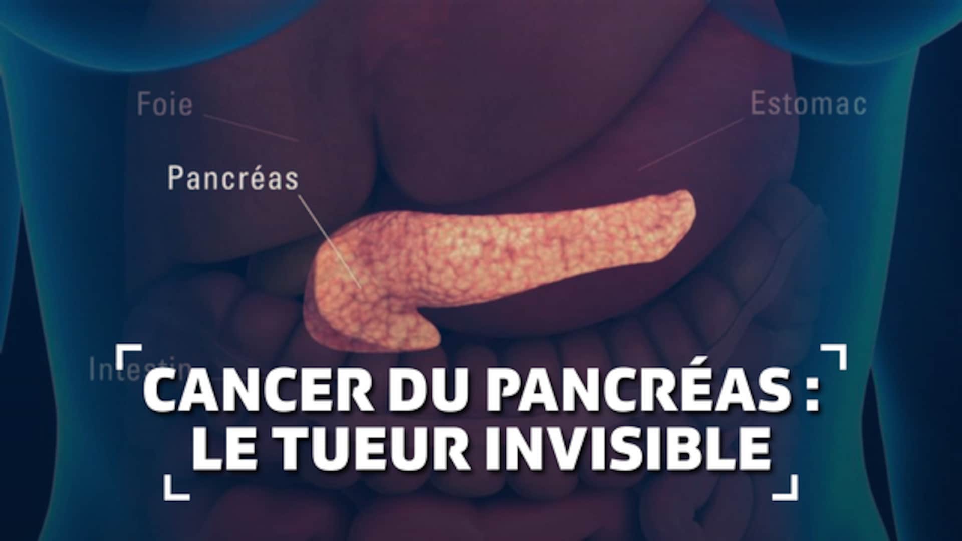 Cancer du pancréas : le tueur invisible