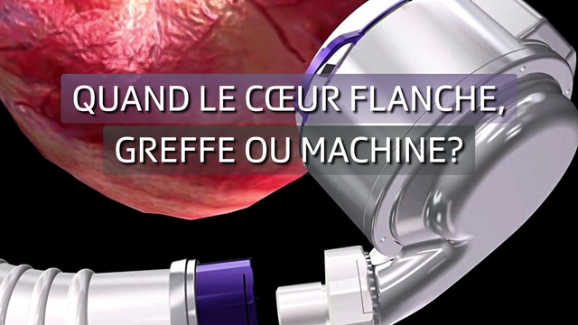 Quand le cœur flanche, greffe ou machine?