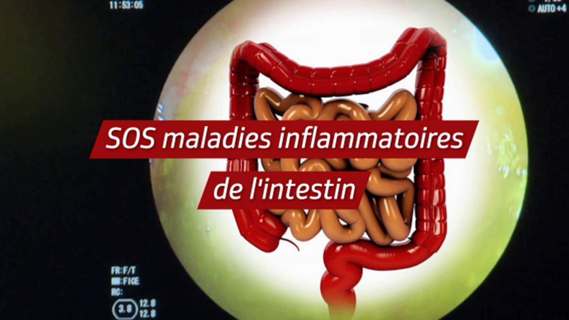 SOS maladies inflammatoires de l'intestin