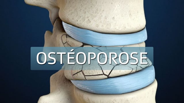 Osteoporose