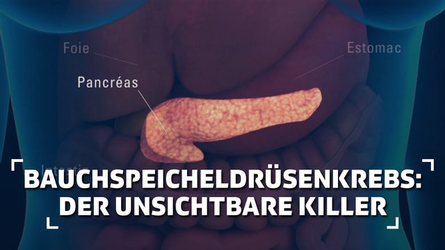 Bauchspeicheldrüsenkrebs: Der unsichtbare Killer