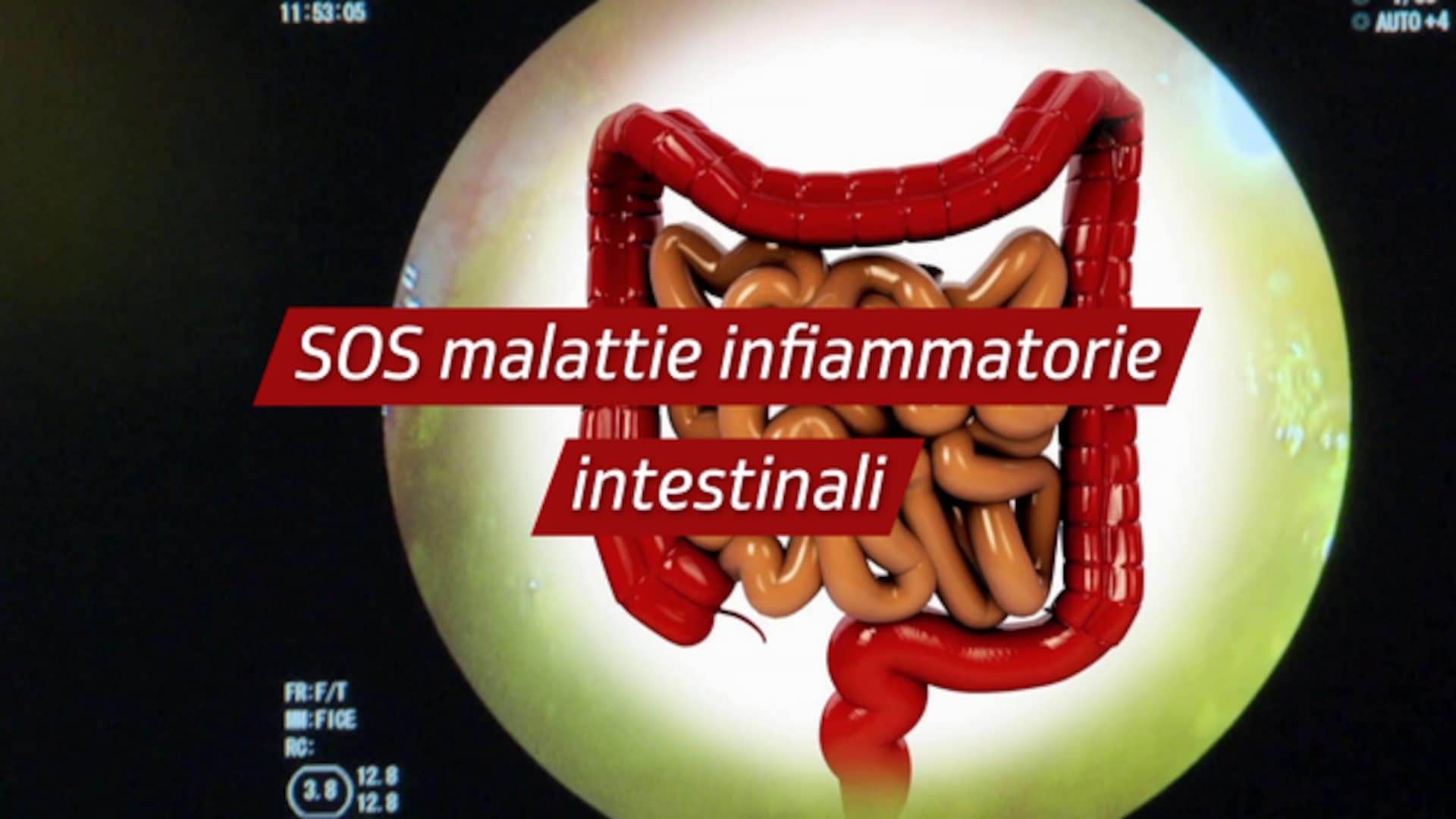 SOS malattie infiammatorie intestinali