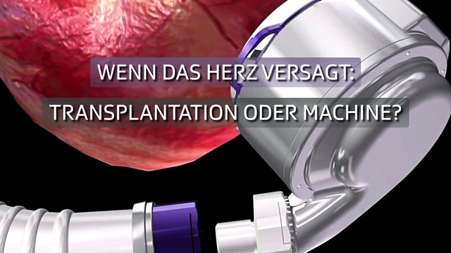 Wenn das Herz versagt: Transplantation oder Machine?