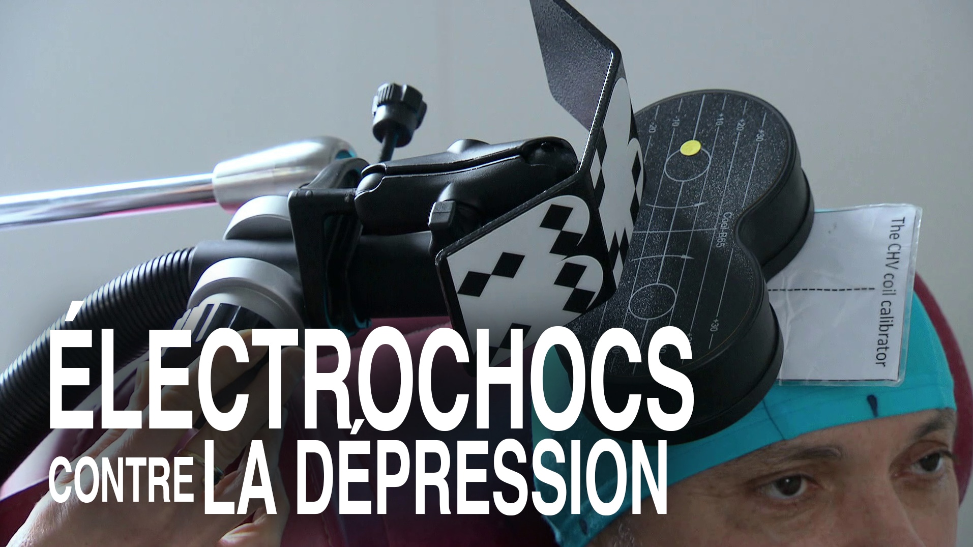 Des électrochocs contre la dépression