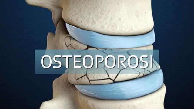 Osteoporosi